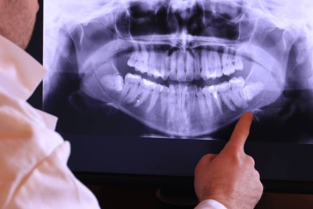 Best Emergency Wisdom Teeth Removal in Glen Head, NY