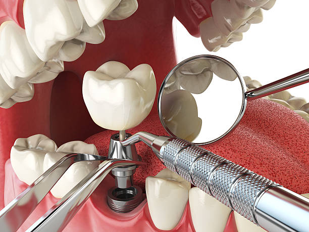 Best Urgent Care for Lost Fillings or Crowns in Glen Head, NY